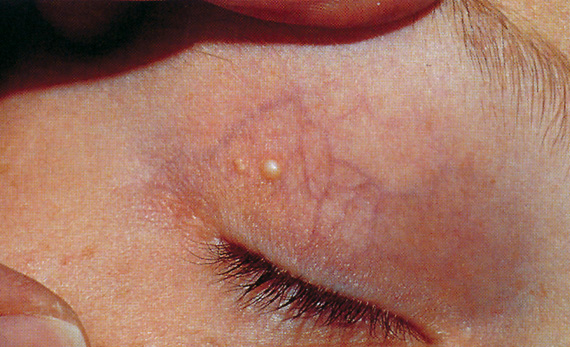 White Bump On Eyelid